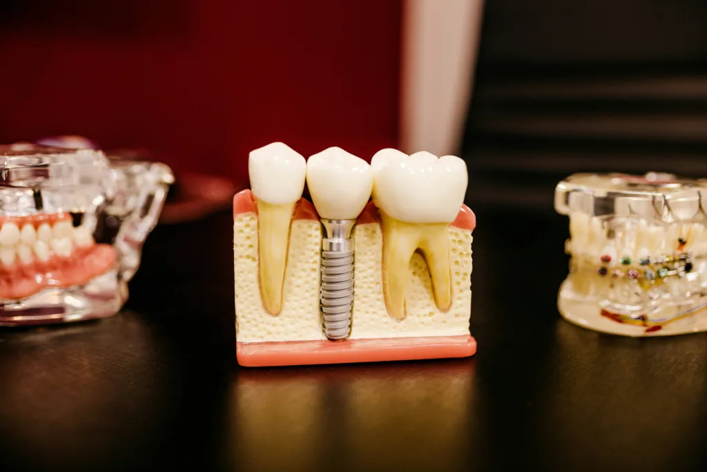 A model of teeth with dental implants