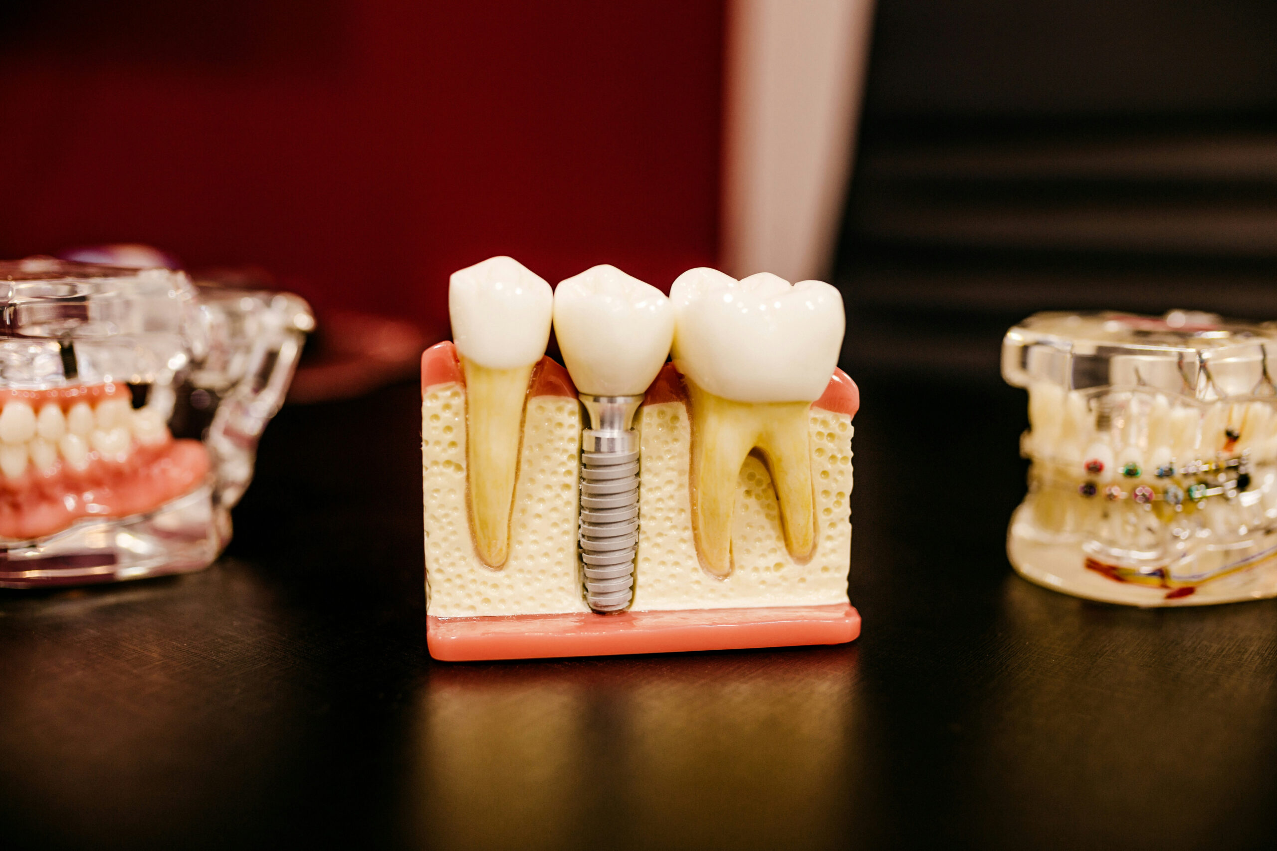 A model of teeth with dental implants